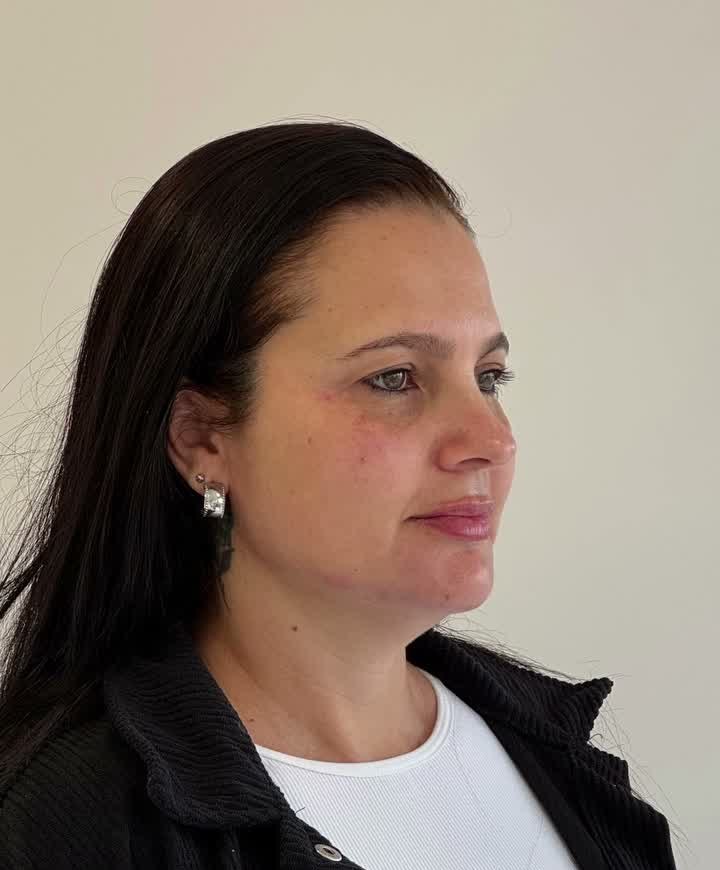 Depois do Full Face, conforme registro publicado pela clínica